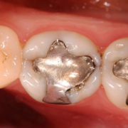Amalgama dentaria mercurio