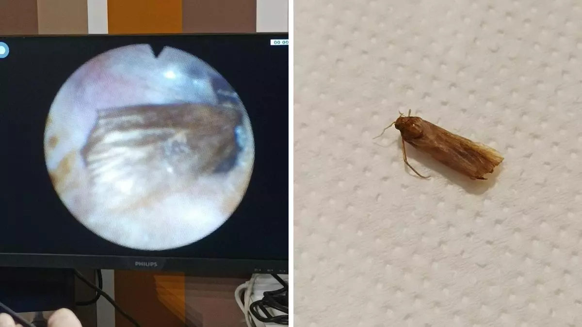 Immagine endoscopica del condotto uditivo con un insetto e, accanto, l’insetto su fondo bianco