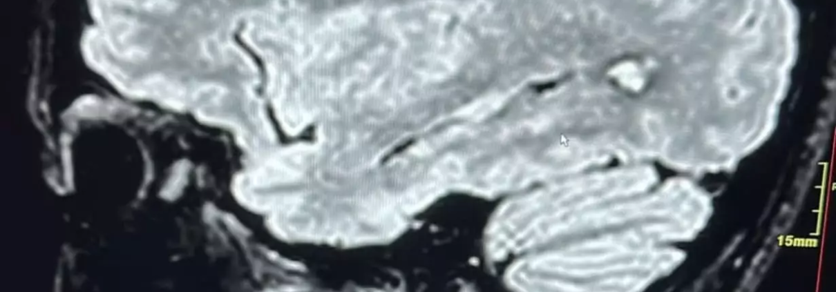 Angioma cavernoso, quando l’acufene può salvarti la vita