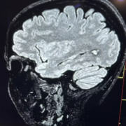 Angioma cavernoso Angioma cavernoso, quando l’acufene può salvarti la vita