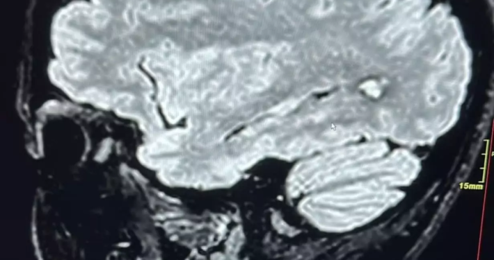 Angioma cavernoso, quando l’acufene può salvarti la vita