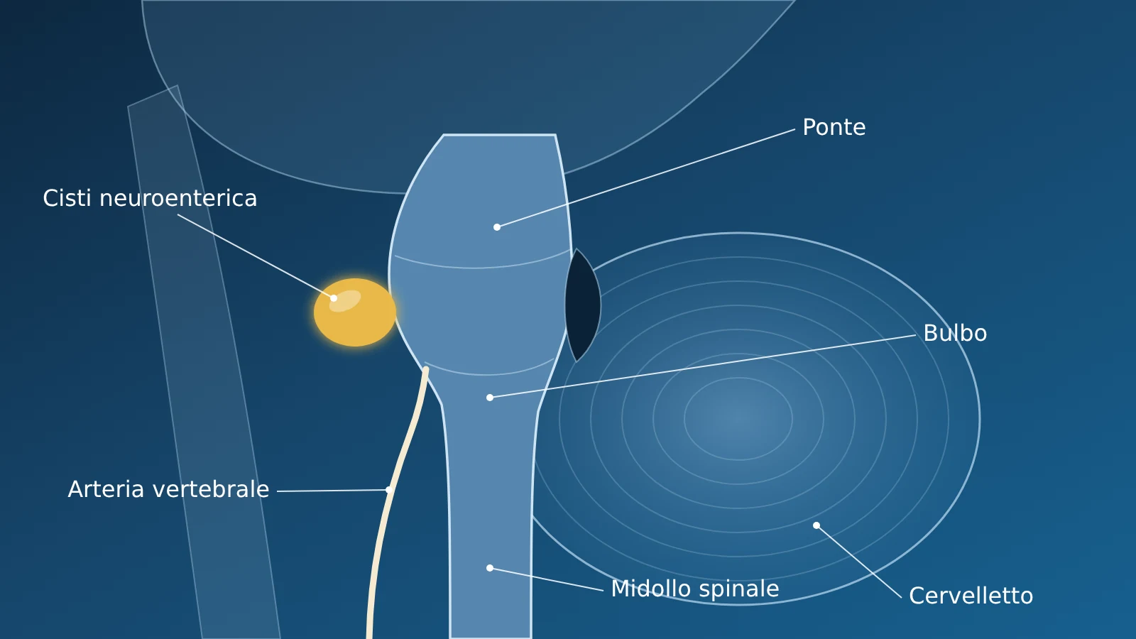 Cisti neuroenterica dell’encefalo: sintomi, diagnosi e monitoraggio