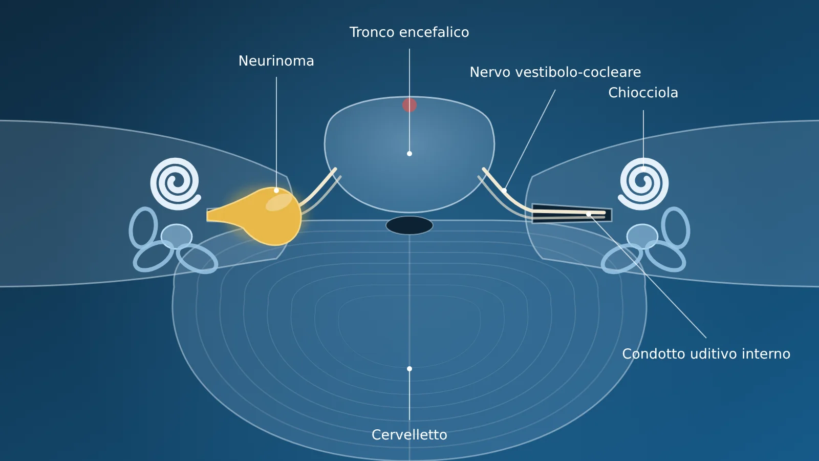 Neurinoma dell’acustico: sintomi, diagnosi e opzioni di trattamento